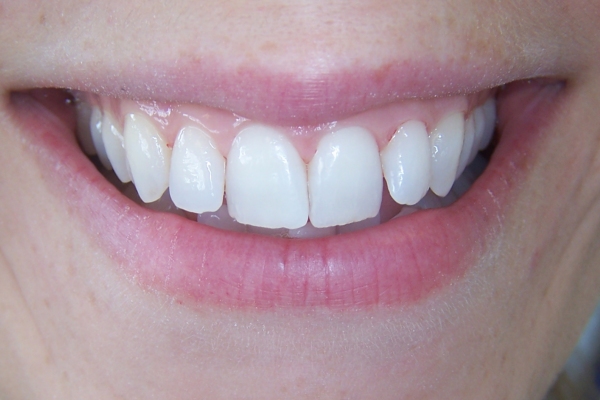 Cosmetic Whitening - After