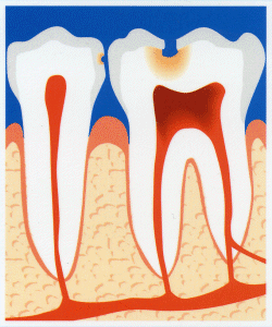 Tooth decay requiring root treatment