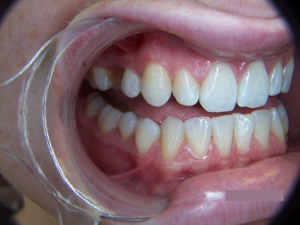 Congenitally missing upper second pre-molars restored with two cantilever maryland adhesive bridges resting on the first molars. Please note metal wings are shown as a mirror image and are not visible on smiling.