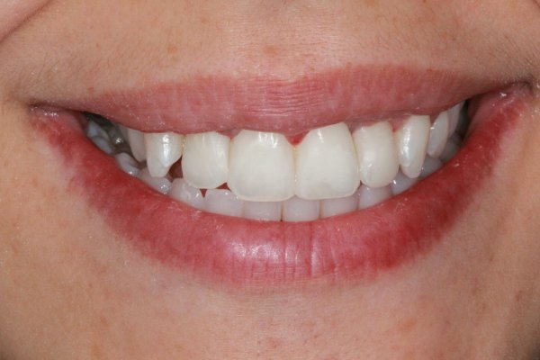 Discoloured anterior composites replaced after cosmetic teeth whitenning and peridontal treatment.