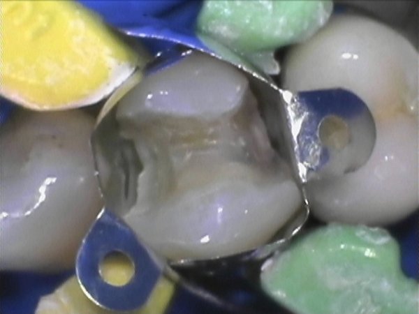 Discoloured and leaking Pre-molar and molar composites replaced with micro-filled direct composites. Tight inter-proximal contacts achieved using a sectional matrix band system.