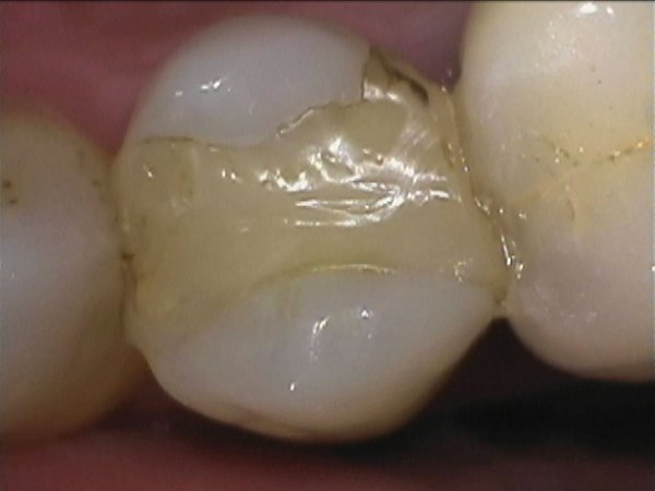 Discoloured and leaking Pre-molar and molar composites replaced with micro-filled direct composites. Tight inter-proximal contacts achieved using a sectional matrix band system.