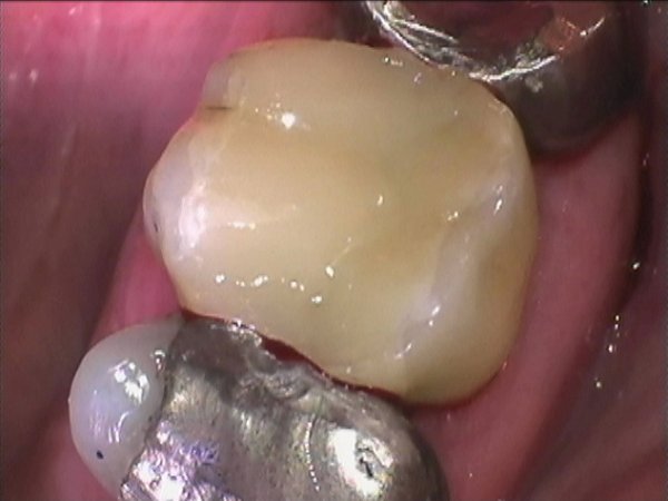 Cracked posterior molar tooth repaired with a direct composite under rubber dam insulation. Maximum wrap around technique used to obtain good bond strength.