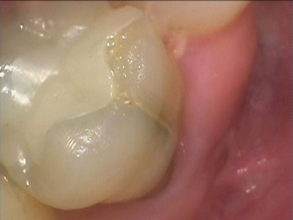 Cracked tooth, restored with a root filling and precious metal alloy crown.