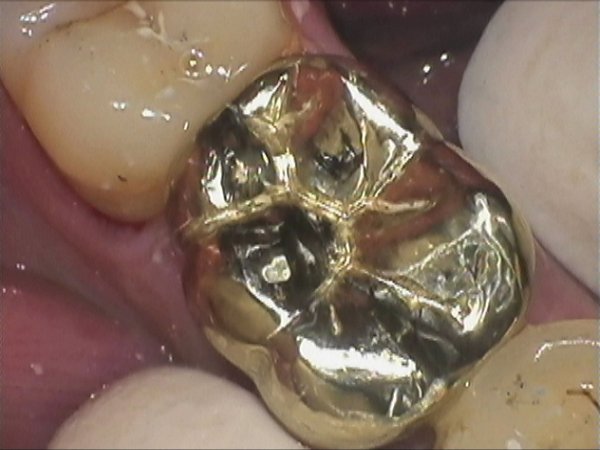 A full gold crown restoration of a cracked porcelain crown. An interim aluminium temporary crown was used.