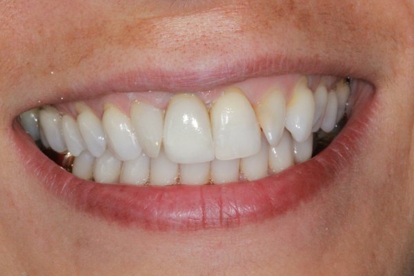 UR1 crown replaced with an all ceramic zirconia crown and root filled with a metal post/core.