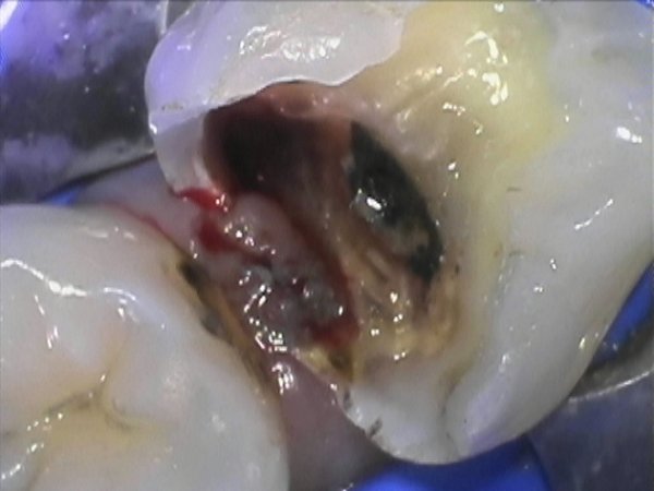 LL6 decayed tooth - root filled under rubber dam isolation and treated with a direct composite.