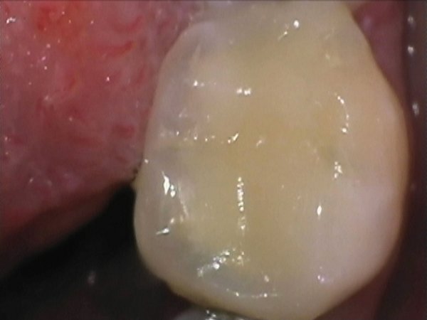 LL6 decayed tooth - root filled under rubber dam isolation and treated with a direct composite.