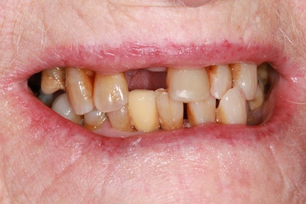 Missing tooth replaced with a small upper partial co/cr denture - Before