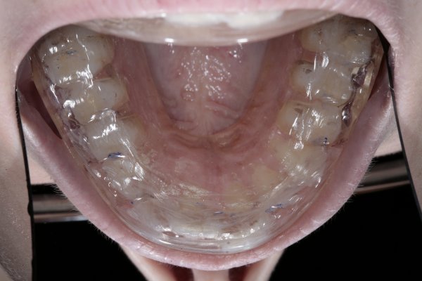 An upper Michigan hard acrylic occlusal splint providing protection from dental parafunctioning.