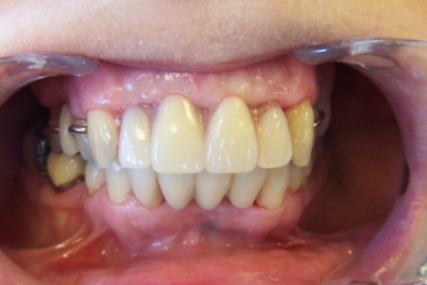 Implant - After
