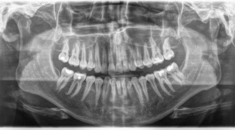 Whole Mouth X-ray